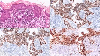 Case report: Vulval sebaceous carcinoma: a report of two cases and literature review focus on treatment and survival